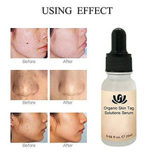 Load image into Gallery viewer, Onkessy Skin Tag Remover Organic Tags Solutions Serum For Fast Removal Moles and Skin Tags Facial Serum for All 20ml

