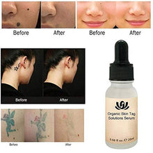 Load image into Gallery viewer, Onkessy Skin Tag Remover Organic Tags Solutions Serum For Fast Removal Moles and Skin Tags Facial Serum for All 20ml
