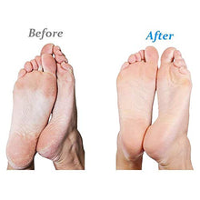 Load image into Gallery viewer, Emjoi Micro-Pedi Callus Remover - (Corded)
