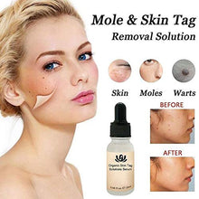 Load image into Gallery viewer, Onkessy Skin Tag Remover Organic Tags Solutions Serum For Fast Removal Moles and Skin Tags Facial Serum for All 20ml
