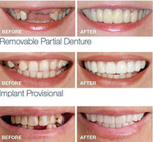 Load image into Gallery viewer, DaMai Denture Cosmetic Teeth, 1 Pair Cosmetic Dentistry Snap On Instant Perfect Smile Comfort Fit Flex Teeth Veneers Teeth Cosmetic Sticker
